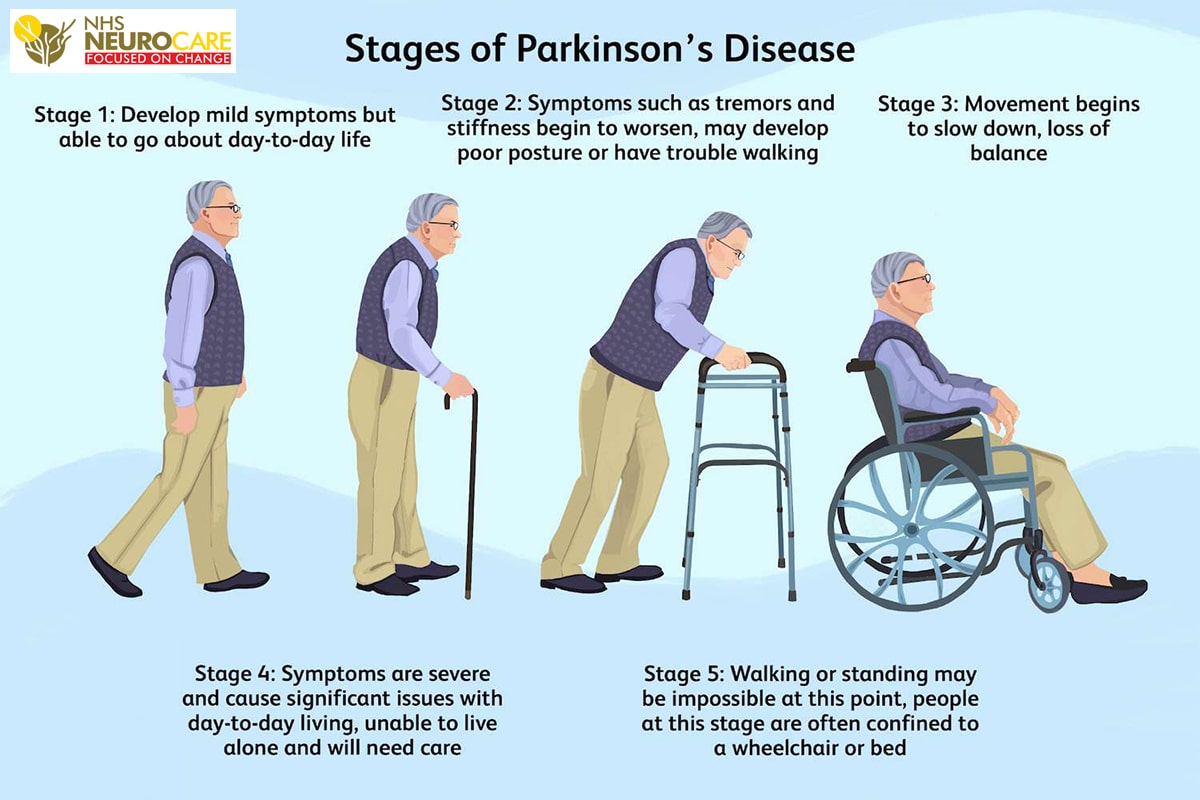 Stages-of-Parkinson-Dr-Sandeep-Goel-Best-neurologist-in-Jalandhar-Punjab-India