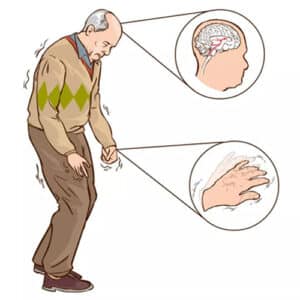 Manage Dyskinesia in Parkinson’s Disease with Our Best Neurologist Dr Sandeep goel
