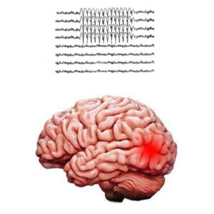 Focal-Seizures-Epilepsy-Attack,-A-Guide-by-Dr.-Sandeep-Goel,-Best-Neurologist-in-Jalandhar,Punjab,India