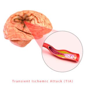 Brain stroke-Transient-ischemic-attack-TIA bestneurologist in jalandhar punjab india